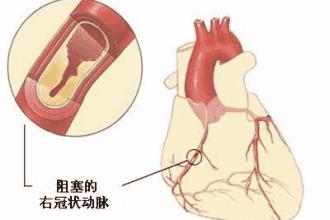 心绞痛的最新分型,时代背景下的深入研究探索