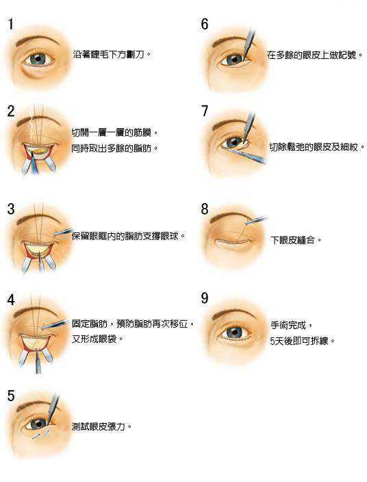 眼部整形新技术
